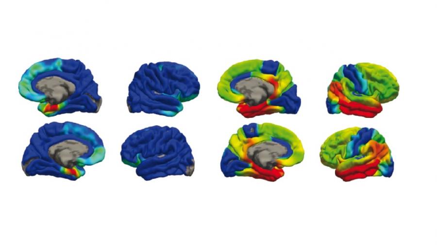 Detección mediante PET da acumulación cerebral da proteína tau en pacientes con PART (esquerda) e con enfermidade de Alzheimer (dereita)