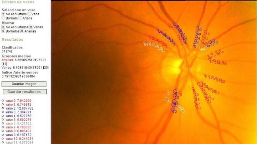 Dúas patentes para unha investigación na que colabora a USC que valida un novo sistema de cálculo do Índice Arterio-Venoso Dúas patentes para unha investigación na que colabora a USC que valida un novo sistema de cálculo do Índice Arterio-Venoso