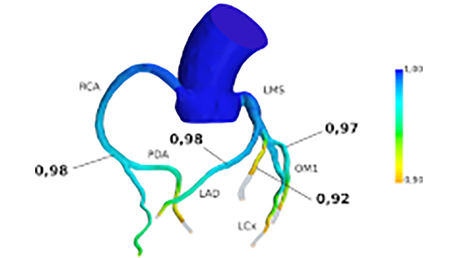 Coronary artheries