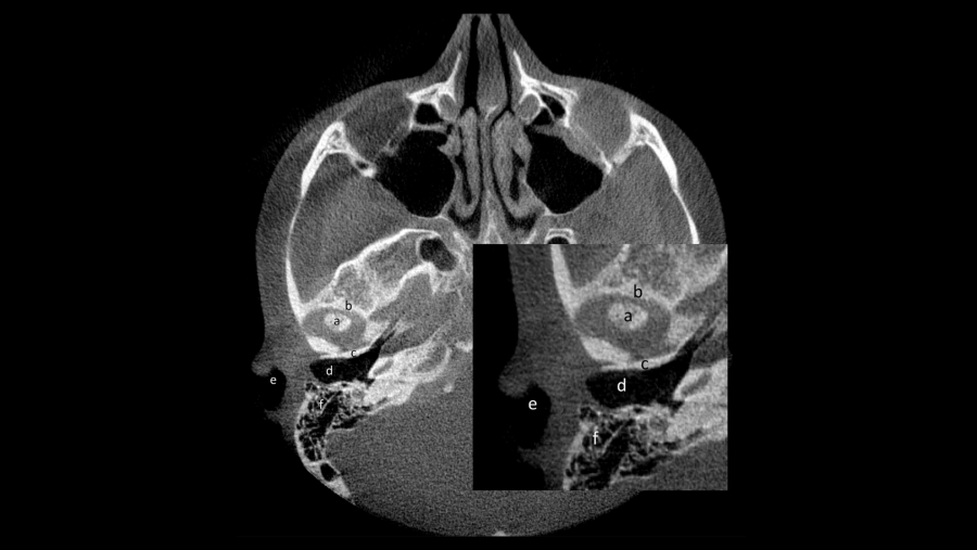 Imaxe ilustrativa da rexión de interese (ROI, polas siglas en inglés) nun corte axial de CBCT. Descrición radiolóxica das partes anatómicas da articulación: (a) cóndilo mandibular da ATM, (b) apófise preglenoidea (óso temporal), (c) apófise postglenoidea (óso temporal). Áreas anatómicas utilizadas para identificar a ATM nun corte axial: (d) trompa de Eustaquio, (e) conduto auditivo externo, (f) apófise mastoides. Imaxe ilustrativa da rexión de interese (ROI, polas siglas en inglés) nun corte axial de CBCT. Descrición radiolóxica das partes anatómicas da articulación: (a) cóndilo mandibular da ATM, (b) apófise preglenoidea (óso temporal), (c) apófise postglenoidea (óso temporal). Áreas anatómicas utilizadas para identificar a ATM nun corte axial: (d) trompa de Eustaquio, (e) conduto auditivo externo, (f) apófise mastoides.